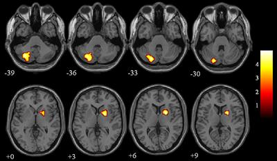 Aberrant Brain Regional Homogeneity and Functional Connectivity of Entorhinal Cortex in Vascular Mild Cognitive Impairment: A Resting-State Functional MRI Study